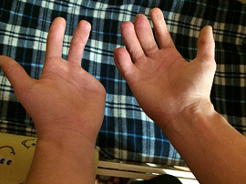 Рука без пальцев - фото №9